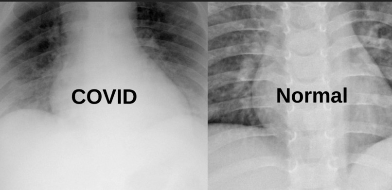 Corona hack chest X-ray – screenshot 1