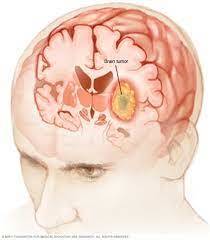 Detection of Cerebral Carcinoma from MRI-101 Bits N' Bytes-2 – screenshot 1