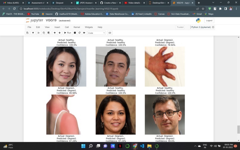 Multiclass Burn wound Classification – screenshot 10