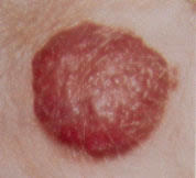Skin disease Prediction Using Deep Learning – screenshot 4