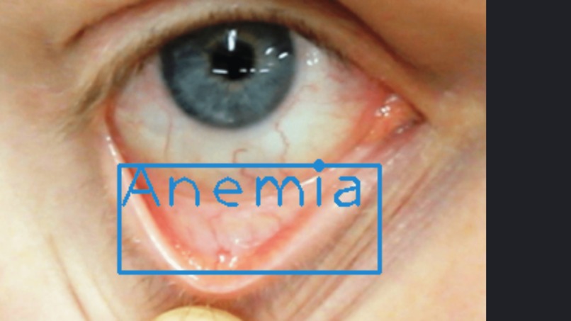 AnemiaDetech – screenshot 1