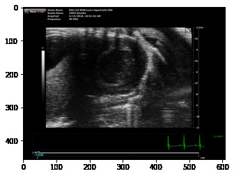 Heart hypertrophy detector – screenshot 3