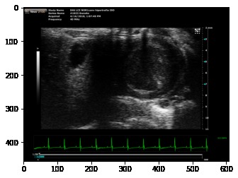 Heart hypertrophy detector – screenshot 4