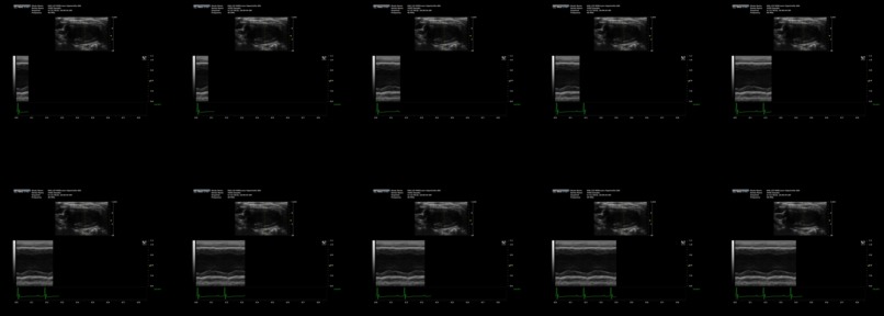 Heart hypertrophy detector – screenshot 5
