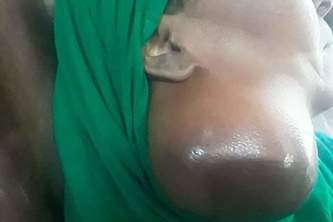 HELPING CANCER PATIENTS IN SOMALIA