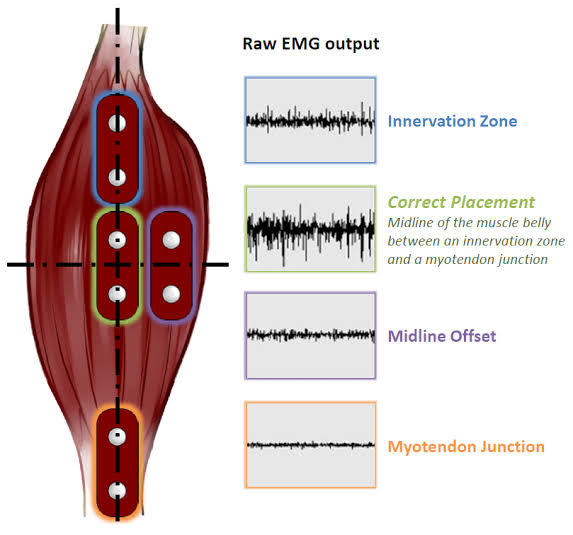 Early Detection Of Muscle Cramp For Sport Person – screenshot 2