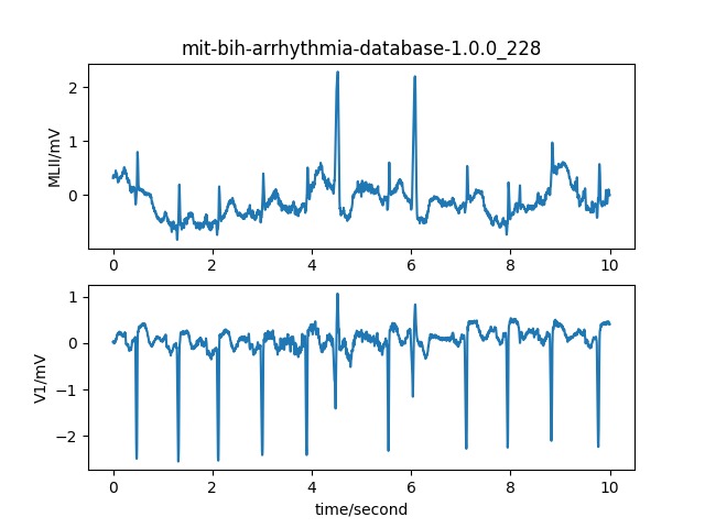 Delving deep into ECG signal quality assessment  – screenshot 3