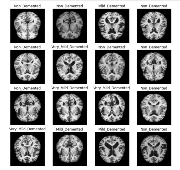 Alzheimer's Detection using ML – screenshot 1