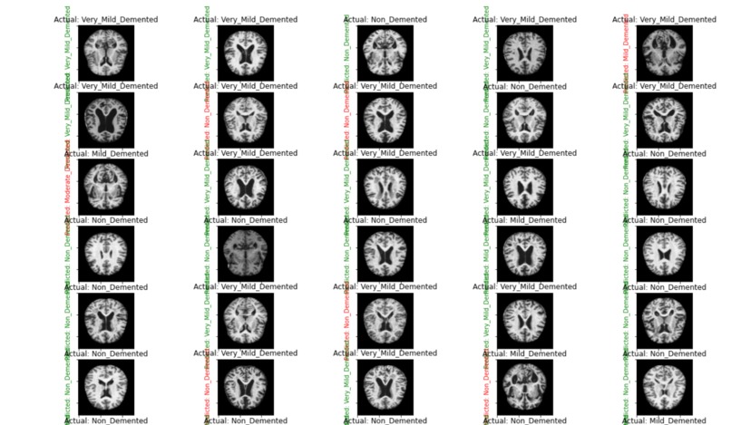 Alzheimer's Detection using ML – screenshot 3