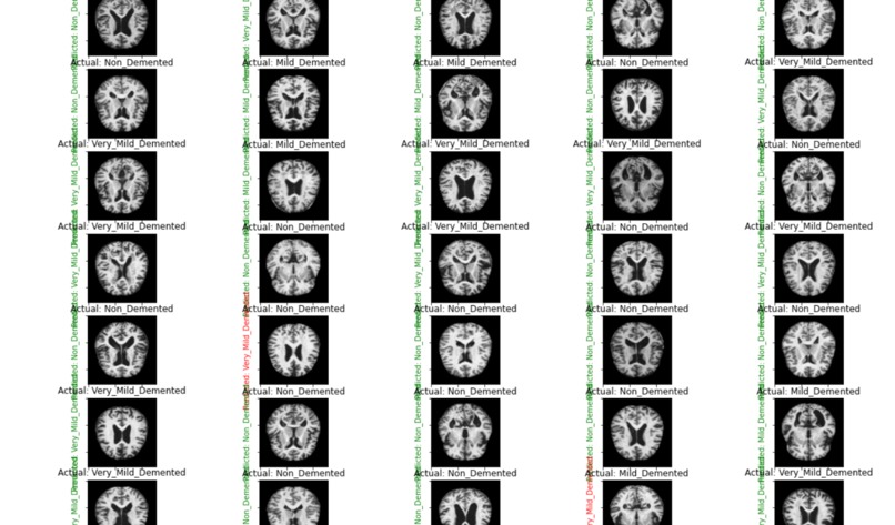 Alzheimer's Detection using ML – screenshot 4