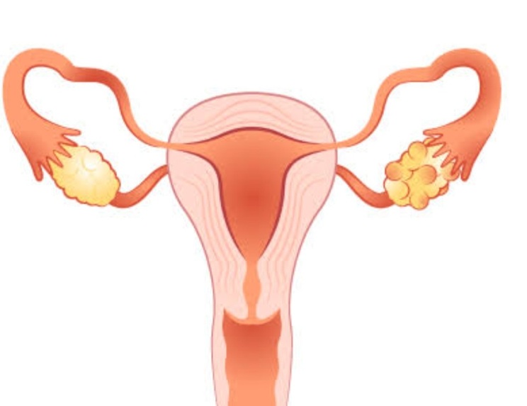 Team 621_detection of pcos – screenshot 1