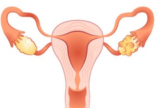 Team 621_detection of pcos