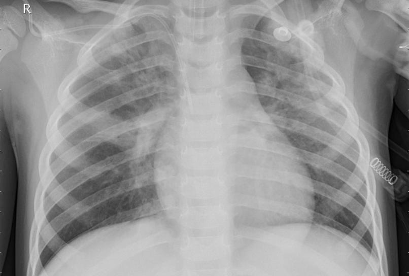 Detection Of Pneumonia. – screenshot 4