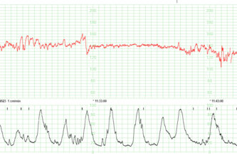 Detección de las características de los RCTG