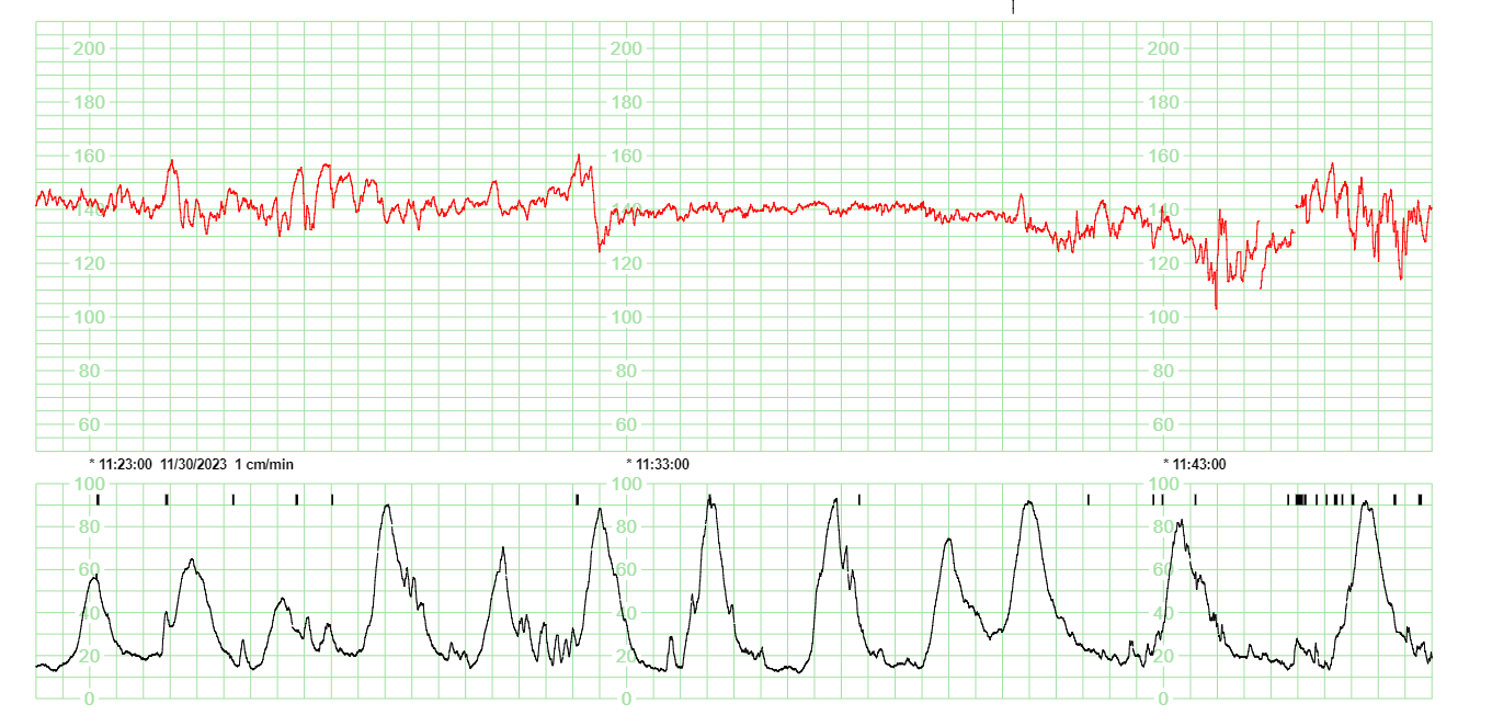Detección de las características de los RCTG | Devpost