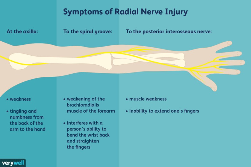 Radial nerve injury – screenshot 1