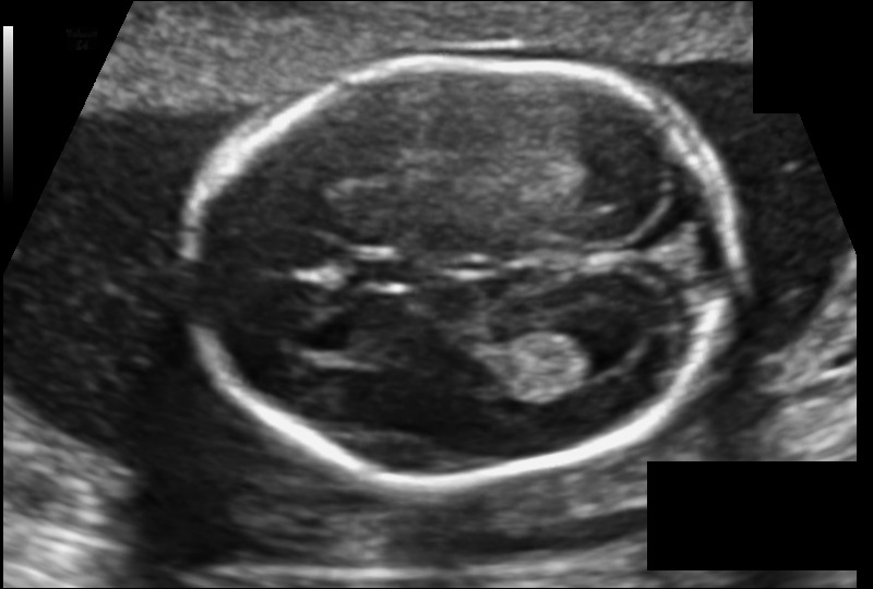 Fetal Head Mesurements – screenshot 1