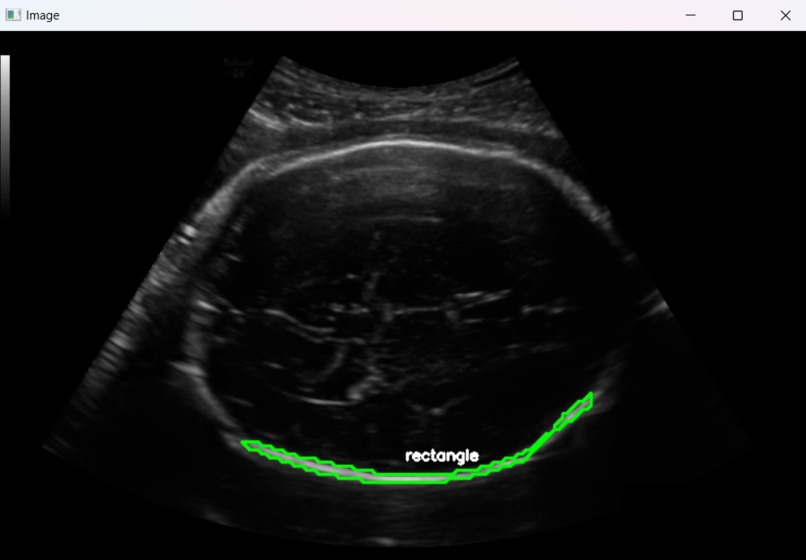 Fetal Head Mesurements – screenshot 3