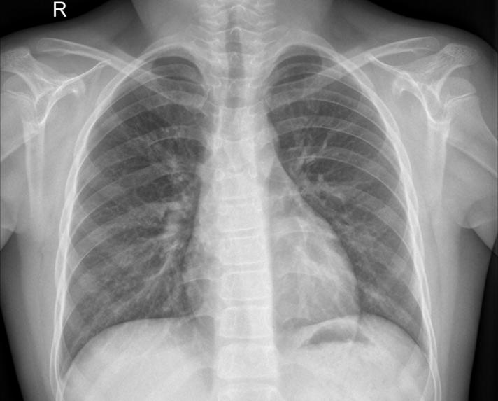 CLOUD APP FOR PNEUMONIA DETECTION WITH  X-RAY IMAGES IN DL – screenshot 1
