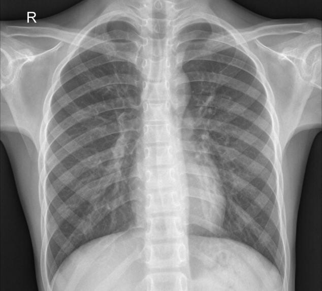 CLOUD APP FOR PNEUMONIA DETECTION WITH  X-RAY IMAGES IN DL – screenshot 3