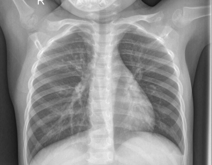 CLOUD APP FOR PNEUMONIA DETECTION  GIVEN X-RAY IMAGES IN DL – screenshot 1