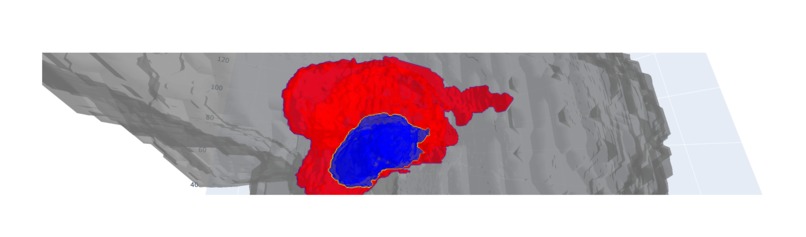 Automatic Efficient Segmentation of Adult Glioma Tumor – screenshot 19