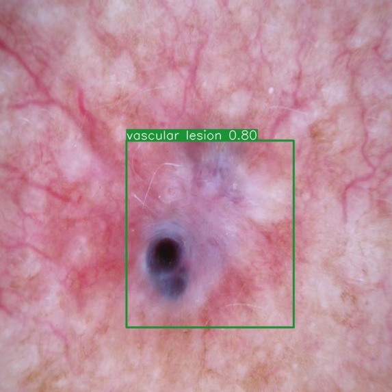 AI: Skin Cancer Detection for Early Intervention  – screenshot 2