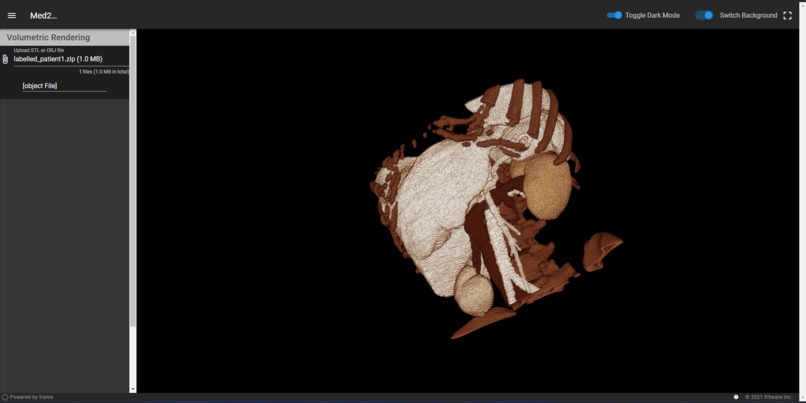 3D reconstruction of 2D Medical Scans – screenshot 2