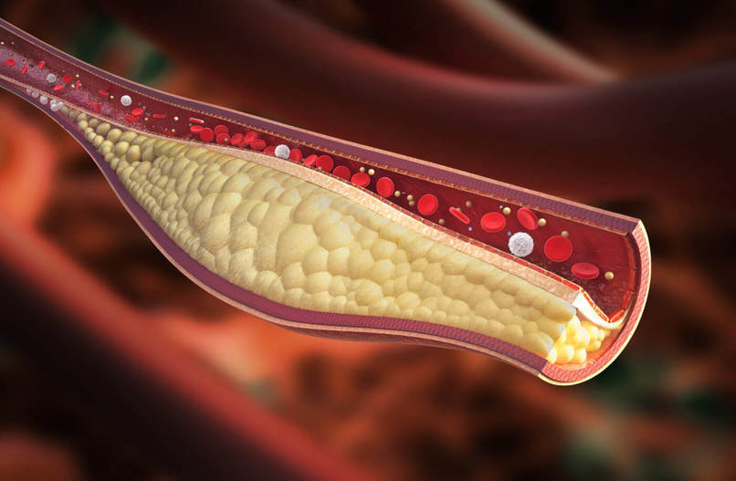 Discover Atherosclerosis – screenshot 1