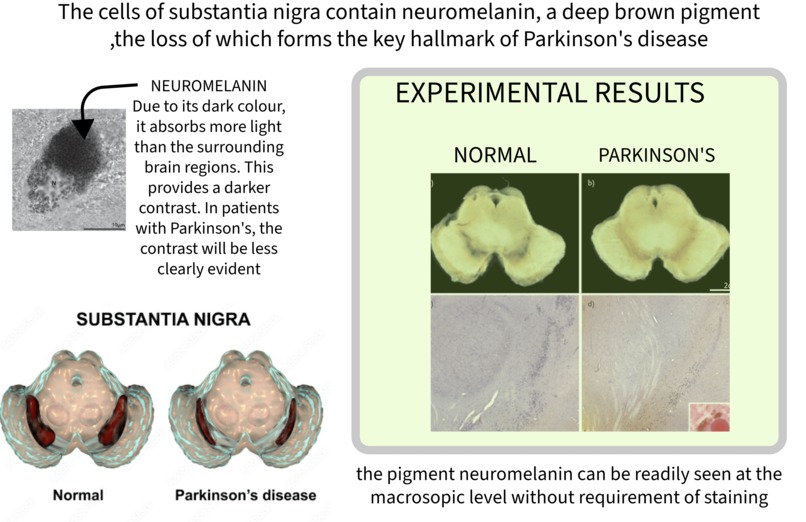 Parkinson's disease Predictor – screenshot 4