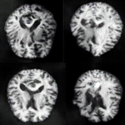 Novel Approach To Improving Accuracy for Alzheimer's  – screenshot 2