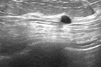 Breast Cancer Predictor