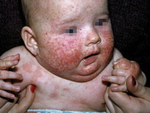 Skin diseases detector – screenshot 2
