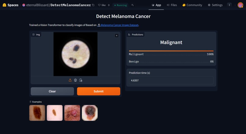 Detect Melonoma Cancer – screenshot 4