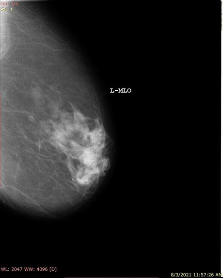 Breast Cancer – screenshot 1
