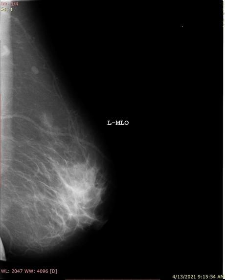 Breast Cancer – screenshot 3