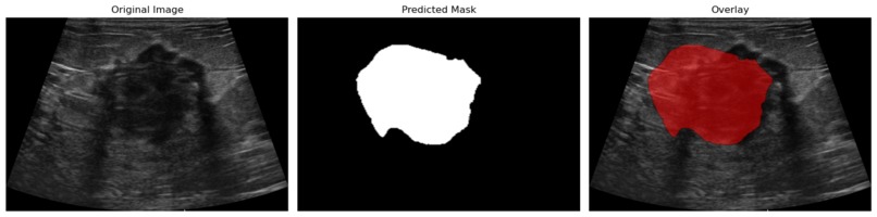 Breast Cancer Tumor Identification and Evaluation – screenshot 1