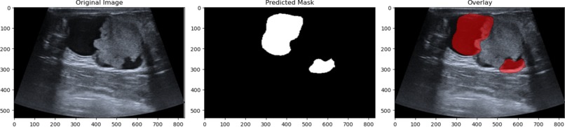 Breast Cancer Tumor Identification and Evaluation – screenshot 2