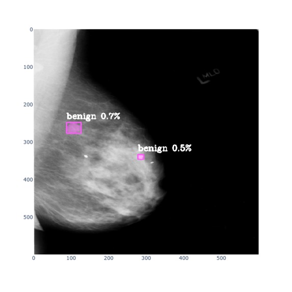 Breast Cancer Detection – screenshot 3