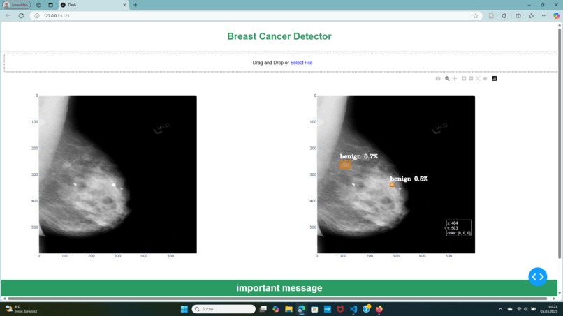 Breast Cancer Detection – screenshot 1