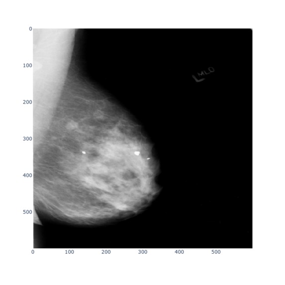 Breast Cancer Detection – screenshot 2