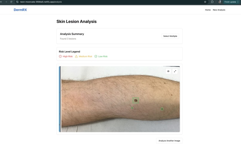 DermRX: AI-Powered Skin Cancer Detection Assistant – screenshot 2