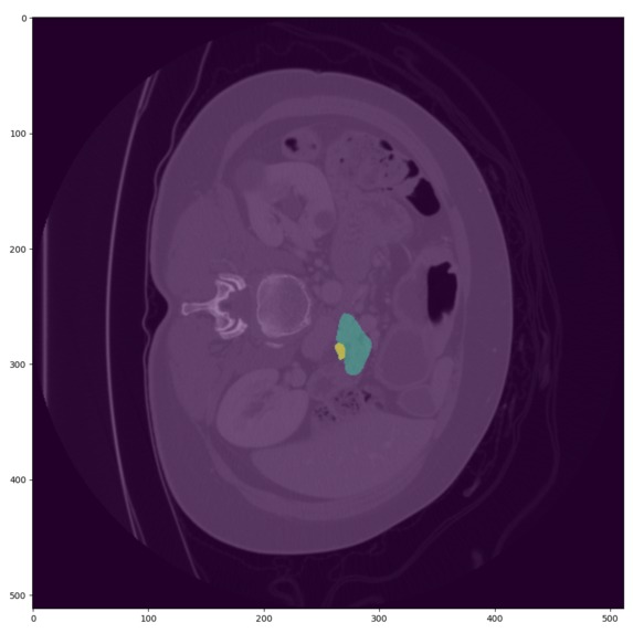 PancreAI – screenshot 4