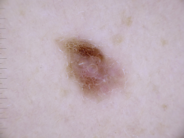 Skin Lesion Identifier  – screenshot 2
