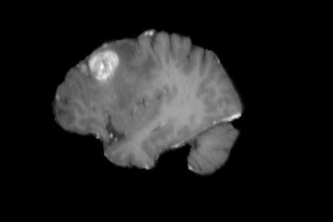 Brain Tumor Detection