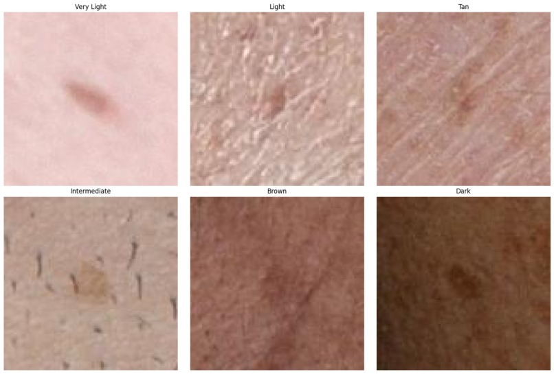 Skin Cancer Detection and Color Bias – screenshot 1
