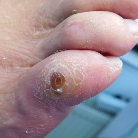 Salvage Diabetic limbs – screenshot 3