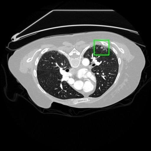 LUNG CANCER DETECTION AND ANALAYSIS WITH AI  – screenshot 1