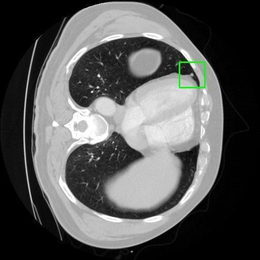 LUNG CANCER DETECTION AND ANALAYSIS WITH AI  – screenshot 2