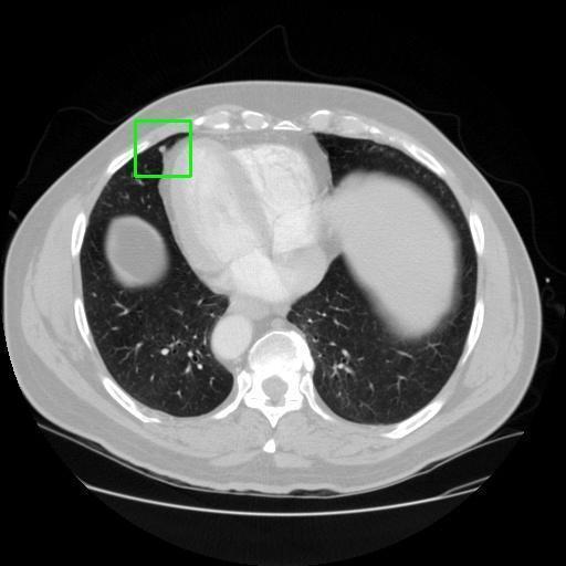 LUNG CANCER DETECTION AND ANALAYSIS WITH AI  – screenshot 3